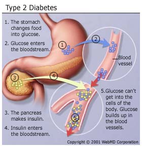 type 2 diabetes diagram