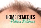These home remedies for pattern baldness won't cost an arm and a leg.